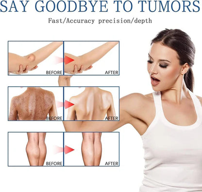 Lipoma Removal Spray