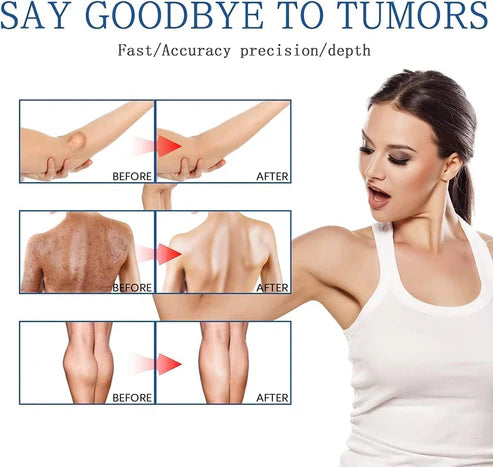 Lipoma Removal Spray